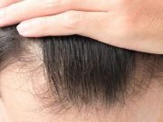 Perdida del cabello por COVID-19 y cómo se recupera